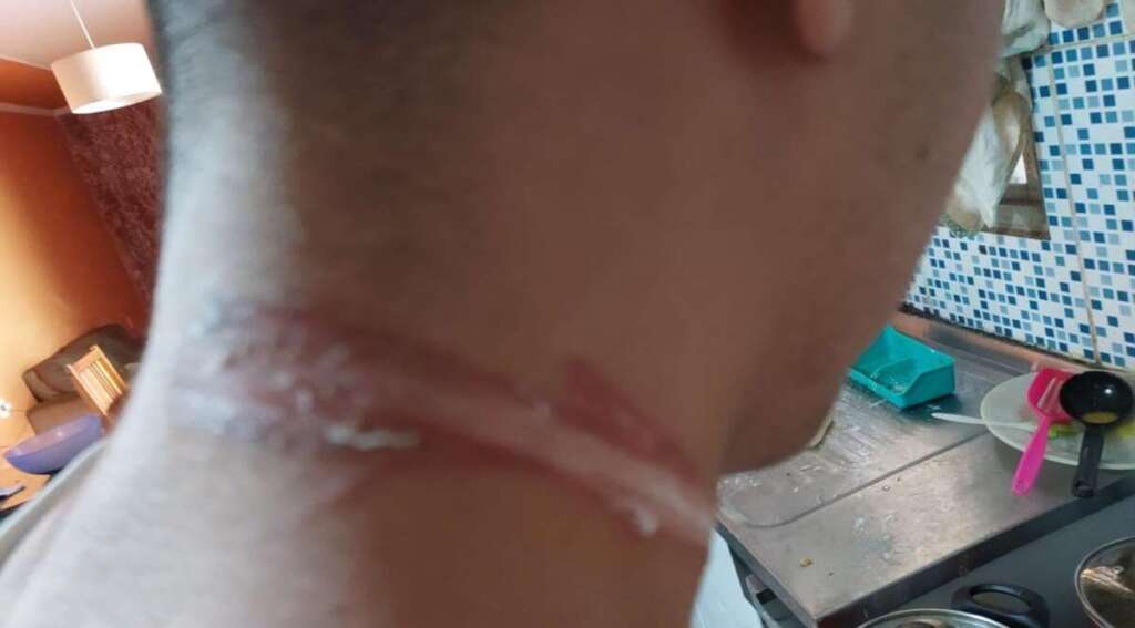 Um jovem por pouco não foi 'degolado' por cabo de Internet. Município não cumpre com Lei Municipal 9 ACIDENTE CABO DE ENERGIA 03 11 23 2