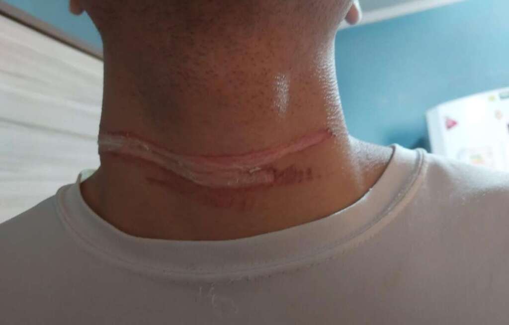 Um jovem por pouco não foi 'degolado' por cabo de Internet. Município não cumpre com Lei Municipal 10 ACIDENTE CABO DE ENERGIA 03 11 23 3