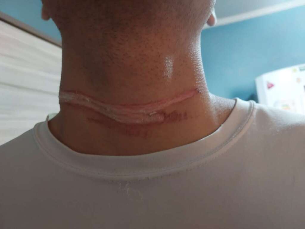 Um jovem por pouco não foi 'degolado' por cabo de Internet. Município não cumpre com Lei Municipal 1 Jovem por pouco não foi 'degolado' por cabo de Internet